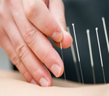 Acupuntura em Alagoinhas